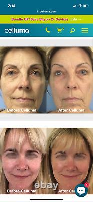 Celluma Pro LED Light Therapy for Anti-aging, Tightening, Wrinkles, Acne & Pain