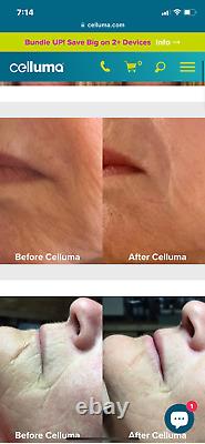 Celluma Pro LED Light Therapy for Anti-aging, Tightening, Wrinkles, Acne & Pain