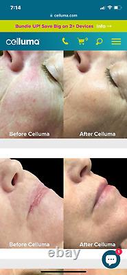 Celluma Pro LED Light Therapy for Anti-aging, Tightening, Wrinkles, Acne & Pain